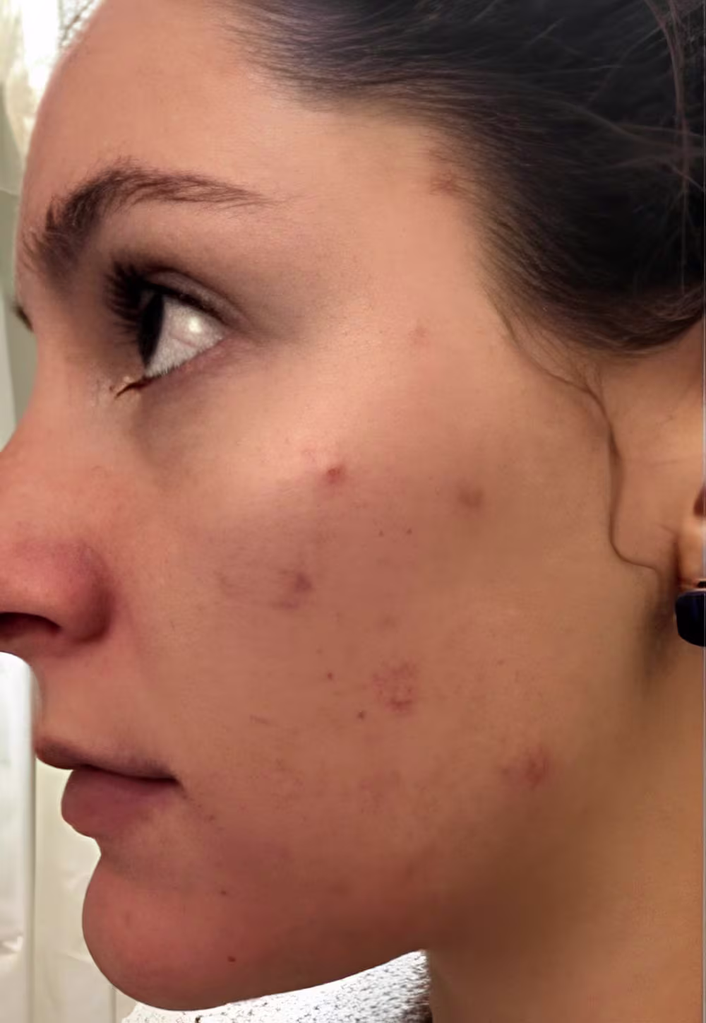 microneedling before