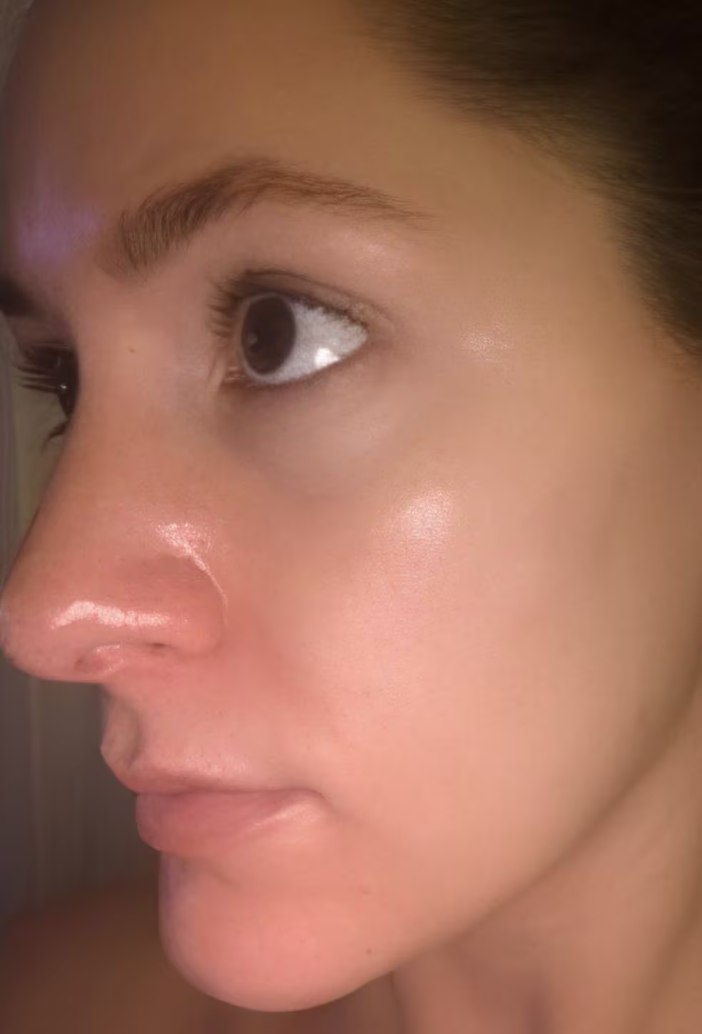 microneedling after
